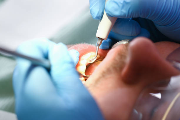 Best Emergency Dental Care for Abscessed Tooth in Mount Vernon, IN